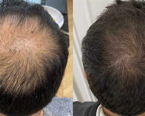 implants capillaires greffes de cheveux Santé Et Remise En Forme