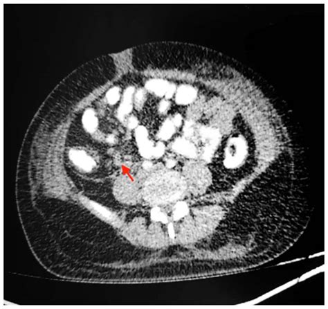 Abdominopelvic Ct Scan Revealing Features Of Mesenteric Adenitis Red Download Scientific