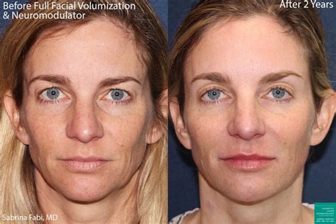 sunken cheeks   treatments cosmetic laser dermatology skin