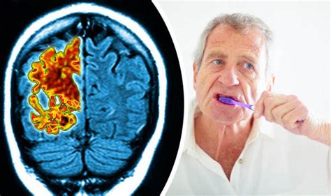 Gum Disease Linked To Cognitive Decline In Alzheimers Patients