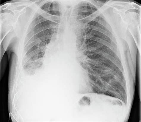 Lung Cancer Pleural Effusion