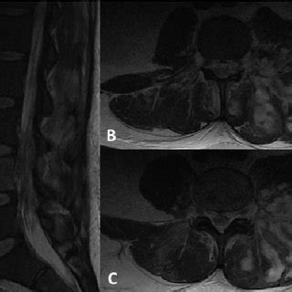 Preoperative T2 Weighted Noncontrast Magnetic Resonance Imaging A