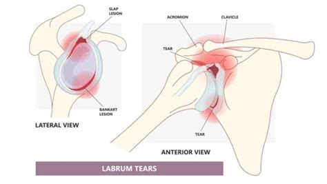 Bankart Lesion | Bankart Lesion Shoulder | Labral Tear Shoulder