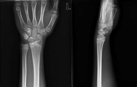 Anteroposterior And Lateral Radiographs Showing The Healed Physeal