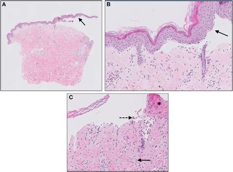 Bullous Pemphigoid Subepidermal Blistering [solid Arrows In A B ] Download Scientific