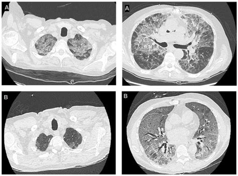 Pathogens Free Full Text Pneumocystis Jirovecii Pneumonia After Heart Transplantation Two