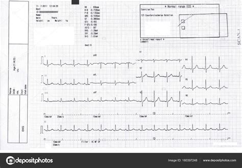 Ekg Ecg Graph Electrocardiogram Ecg On Paper Stock Photo By ©v74