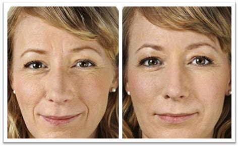 Botox Before And After Frown Lines