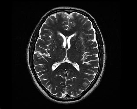 T Mri T Weighted Mri Sequence Physics And Image Appearance