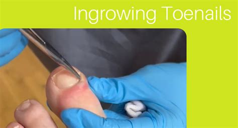 7 Causes Of Ingrown Toenails Flawless Feet Podiatry Blog