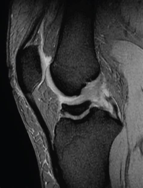 A Preoperative Stir Image Of Mri Showing Poor Delineation Of The Acl Download Scientific