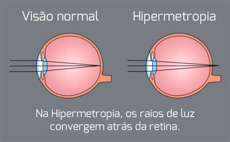 Hipermetropia Causas Sintomas e Tratamento Clínica Oftalmed