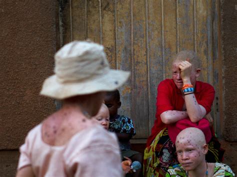 Tanzania S Albinos Face Constant Threat Of Attack Npr