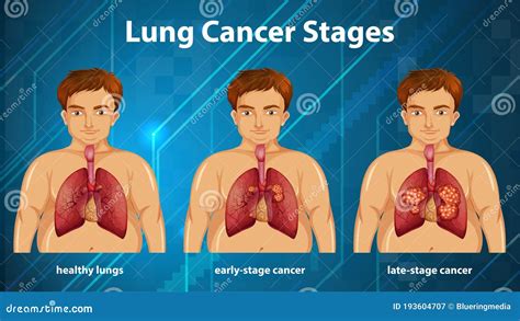 Informative Illustration Of Lung Cancer Stages Stock Vector