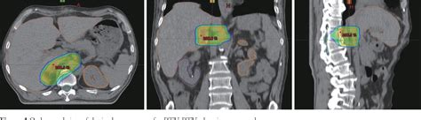 Figure 1 From Radiotherapy Of Malignant Pheochromocytoma—a Case Report Semantic Scholar