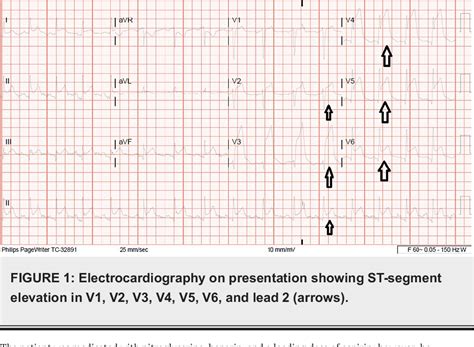 Figure From Cannabis Induced St Segment Elevation Myocardial