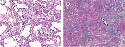 Interstitial Lung Disease Histology