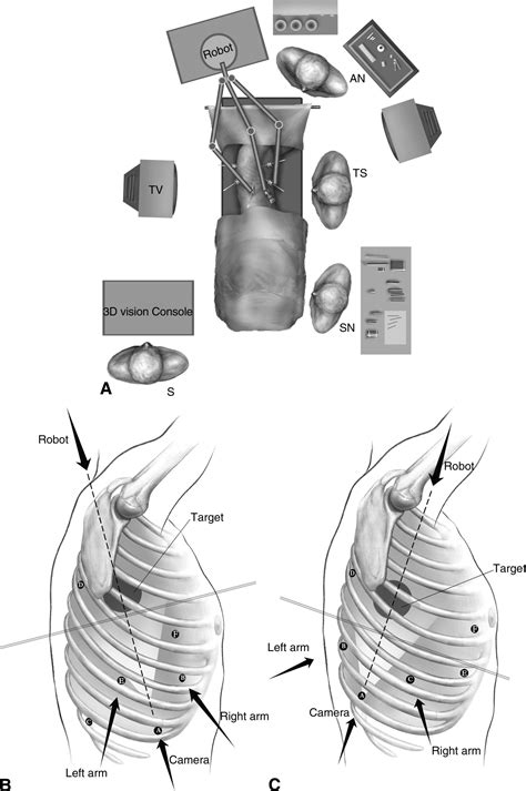 Robotic Lobectomy Operative Techniques In Thoracic And Cardiovascular Surgery