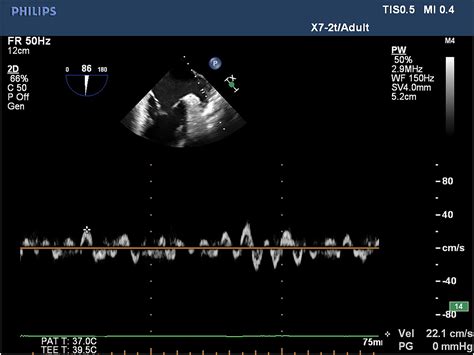 Relationship Between Left Atrial Appendage Peak Flow Velocity And