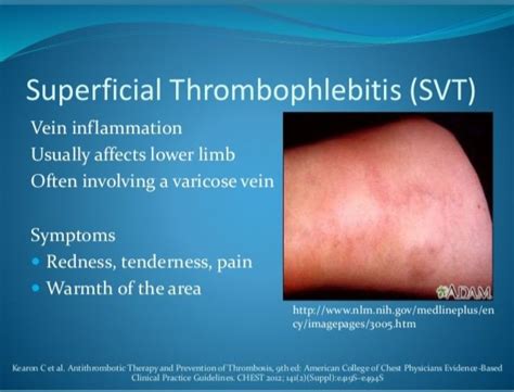 Superficial Thrombophlebitis