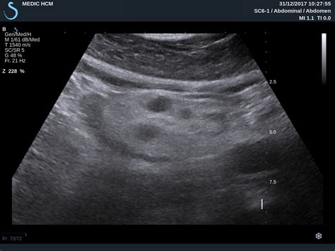 Vietnamese Medic Ultrasound Case Mesenteric Lymphoma Dr Phan