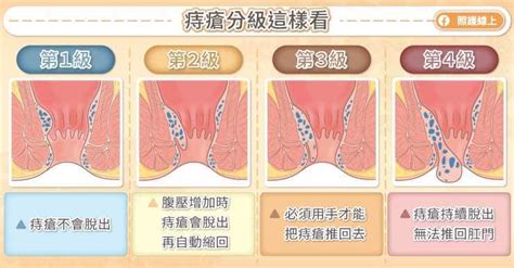 痔瘡一直掉出來該怎麼辦？醫解析何時該動刀及治療方式差異｜一般外科｜醫療｜元氣網