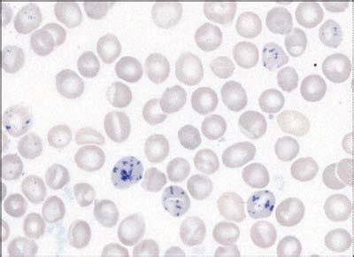 Reticulocytosis. Not all reticulocytes are stained or graded equally ...