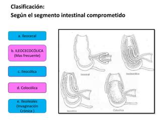 Invaginacion En Pediatria Y Puericultura Pptx