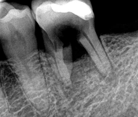 Radiolog A De La Caries Dental Directorio Odontol Gico