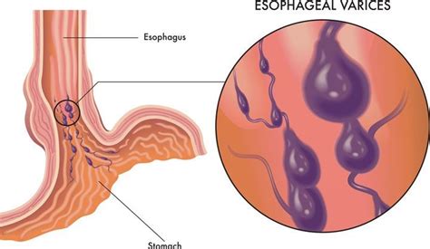 Varises Esofagus Gejala Penyebab Diagnosis Pengobatan