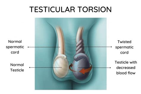 Testicular Torsion Following Inguinal Hernia Surgery A Detailed Study