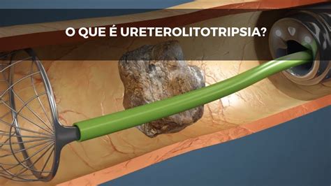 O Que Ureterolitotripsia Cirurgia De Pedra Nos Rins Youtube