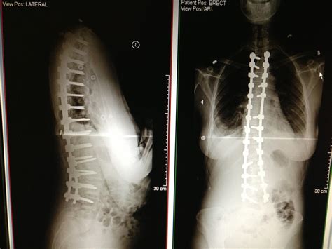 scoliosis surgery | The Stork and the Beanstalk