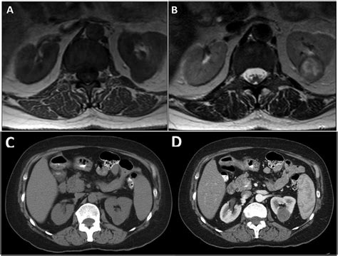 Mri And Ct Urogram Depicting Left Renal Mass A Magnetic Resonance Download Scientific