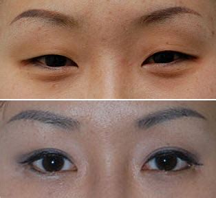 Asian Blepharoplasty Creating A Double Fold With Upper Eyelid Surgery