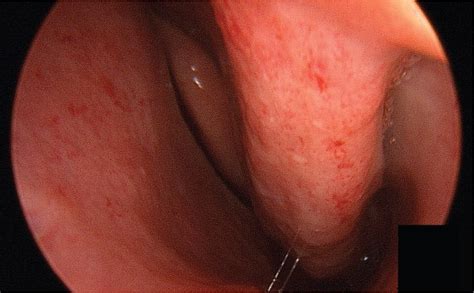 Hereditary Hemorrhagic Telangiectasia Endoscopy