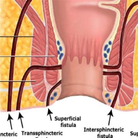 Fistulas Fistula Anal Fistula Av Fistula Tracheoesophageal The Best