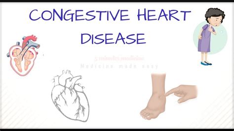 Congestive Heart Disease Definition Risk Factors Diagnosis And Treatment Youtube