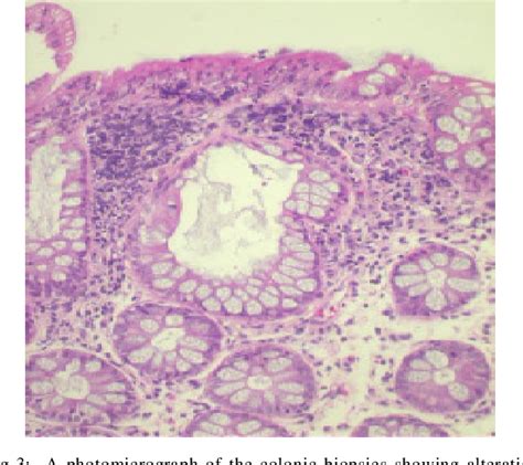 Figure 3 from Spectrum of microscopic colitis in a tertiary care centre ...