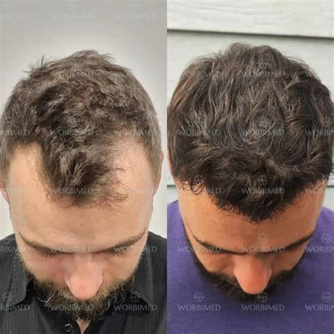 3000 Grafts Hair Transplant L Results Cost 2024