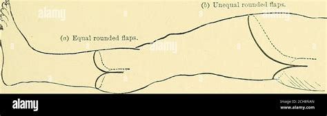 Text Book Of Operative Surgery Iv Two Longitudinal Incisions Added