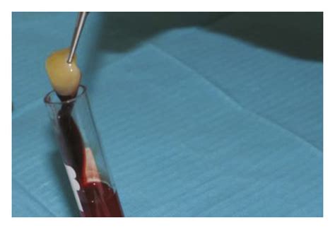 (a) Blood sample after centrifugation. (b) Extracting the PRF clot from ...