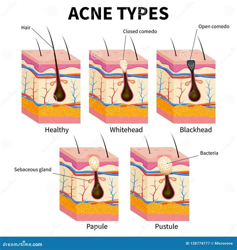 Tipos Del Acné Diagrama Médico Del Vector De La Anatomía De Las