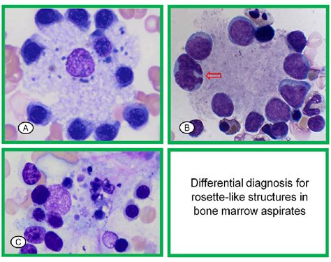 Suckling Erythroid Precursors And Mimickers In Bone Marrow Aspirates