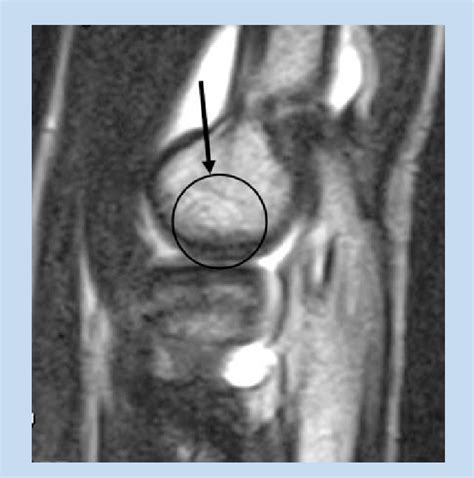Sagittal Mri Of The Elbow In A 14 Year Old Gymnast With Lateral Elbow