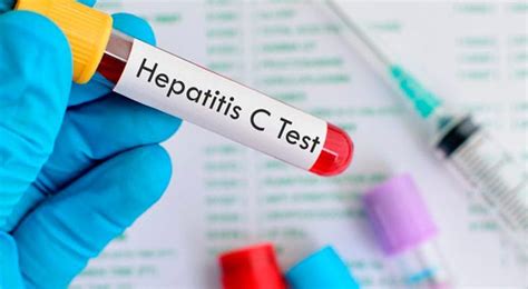 QuÉ Es La Hepatitis C Y CÓmo Detectarla