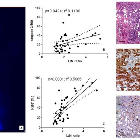 Breast Specific Imaging With Mtc Tc Sestamibi And Both Caspase