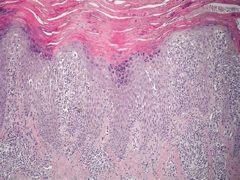 Histology Of Irritant Contact Dermatitis Skin Lesion Acanthotic