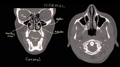 Nasal Polyps Youtube