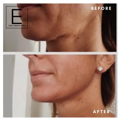 Jawline Chin Options Using Dermal Filler Anti Wrinkle Toxin